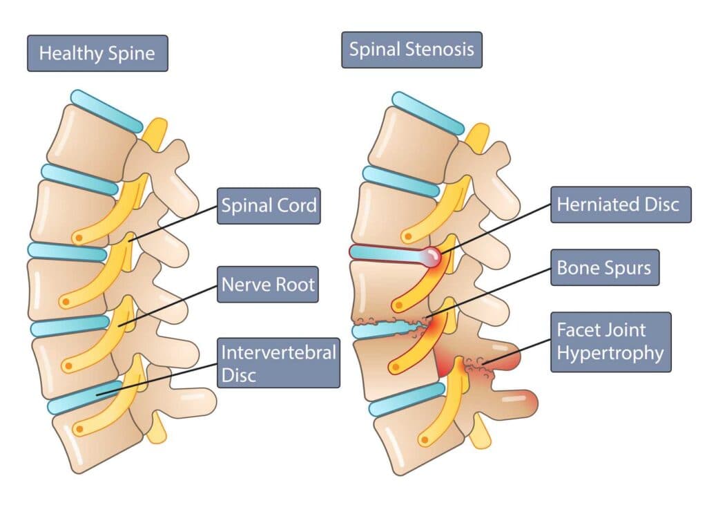 Lumbar Spinal Stenosis (Narrowing of the Spinal Canal)